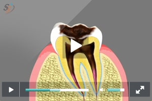 Progression of Dental Decay