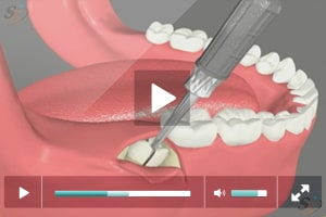 Third Molar Extraction - Mesio Angular