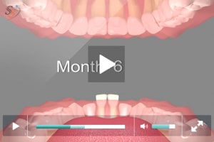 Eruption Sequence Of Teeth