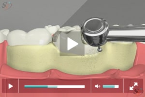 Crown Lengthening(With Bur Tool) - Scenario III