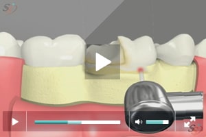 Crown Lengthening(With Laser Tool) - Scenario II