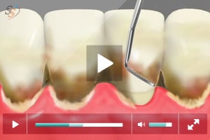 Initial Periodontitis