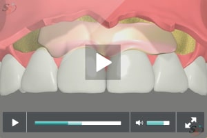 Soft Tissue Grafting - Scenario II