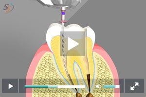 Root Canal Treatment